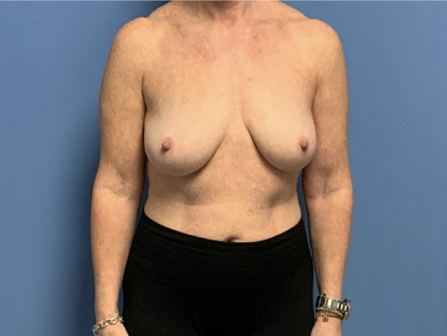 Breast-Lift--Case-Study-6279 | Before Breast